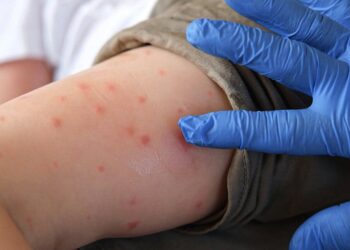 Pennsylvania measles deaths reported in unvaccinated Lancaster residents