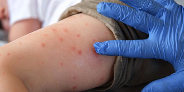 Pennsylvania measles deaths reported in unvaccinated Lancaster residents